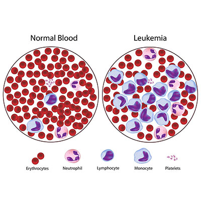 Examination of Pathological Slides of Leukemia: